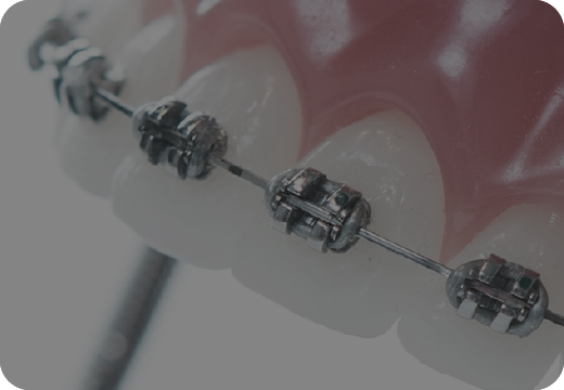 歯科矯正用ブラケット